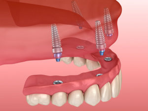 prótese dentária